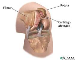 Condromalacia rodilla