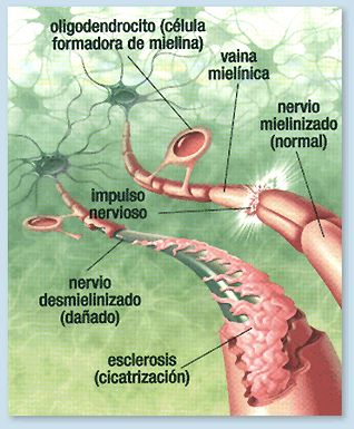 Causas De La Esclerosis Multiple Pdf