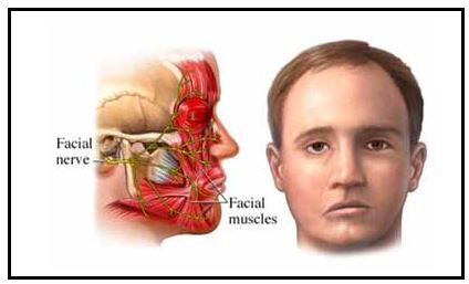 Etiologia da Paralisia Facial