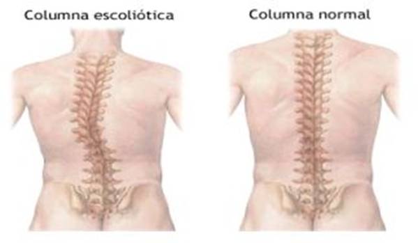 Anatomía de la espalda humana. Lesiones y patologías