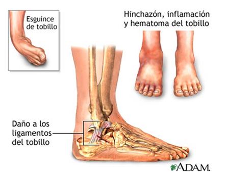 Rizado pronto Revolucionario Inversión de tobillo en jugadores de baloncesto: causas, prevención,  tratamientos y rehabilitación