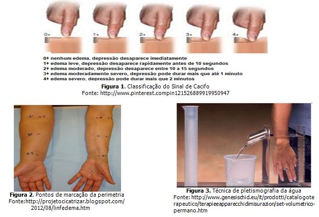 A importância da drenagem linfática manual no tratamento de linfedema pós  mastectomia. Uma revisão da literatura