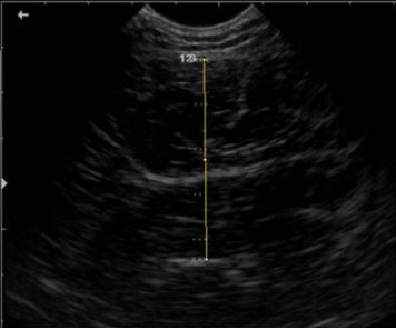 Figura 2. Avaliação da espessura muscular do quadríceps femoral por ultrassonografia